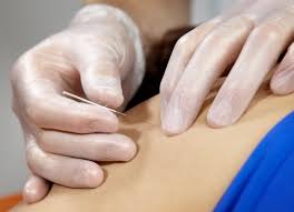 dryneedling